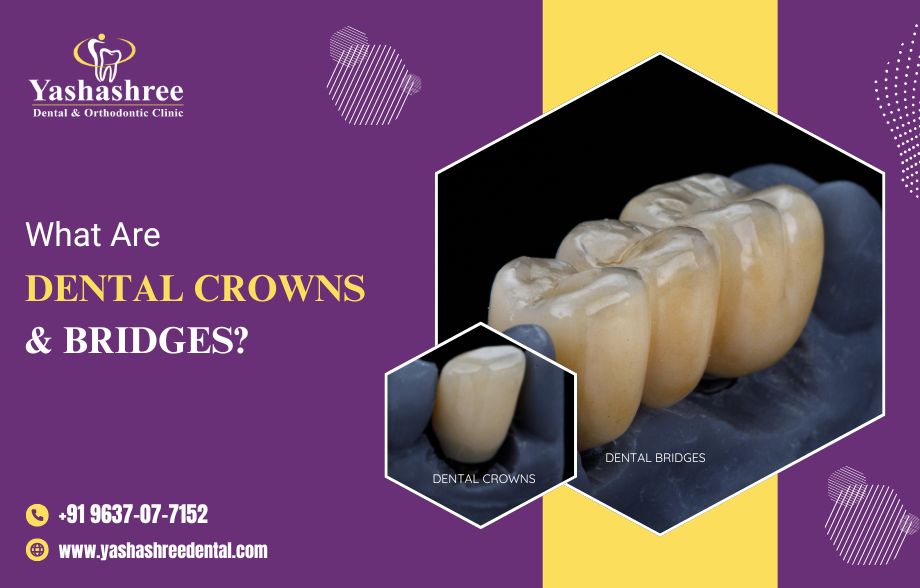  What Are Dental Crowns and Bridges? A Simple Guide