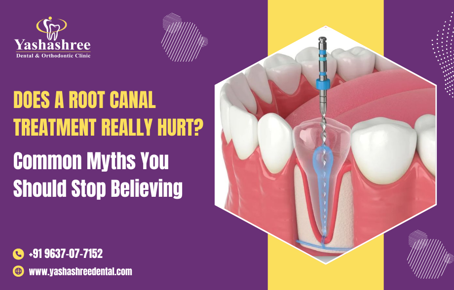 Does a Root Canal Treatment Really Hurt? Common Myths You Should Stop Believing